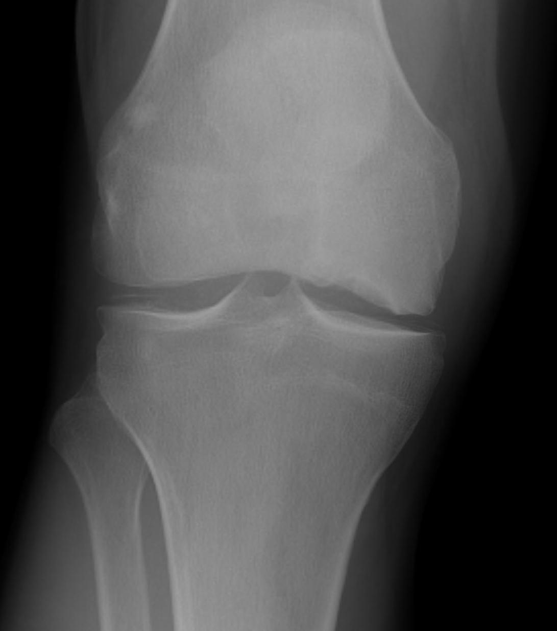 Spontaneous Osteonecrosis of the Knee